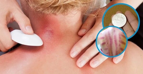 Cạo gió giác hơi là những phương pháp trị liệu dân gian