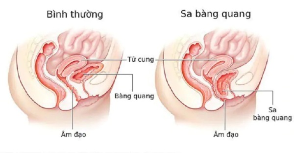 Cải thiện chức năng kiểm soát bàng quang ở phái nữ