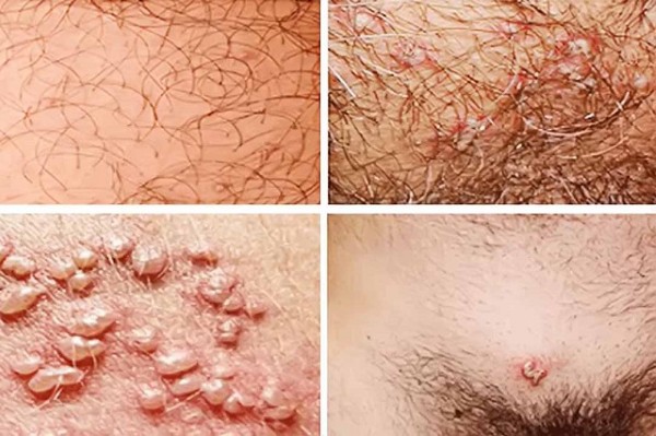 Mụn rộp sinh dục