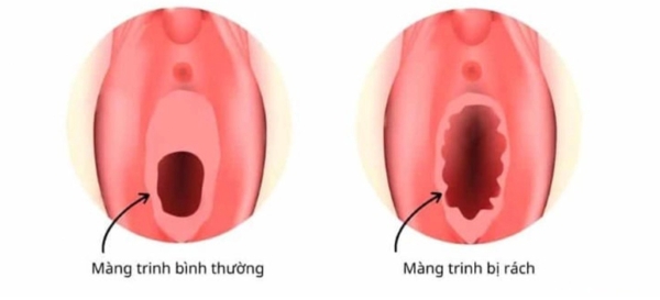 Cảm giác sau khi màng trinh bị rách sẽ như thế nào?
