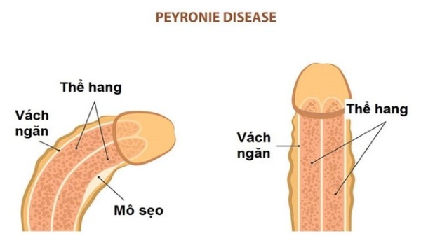 Dương vật cong hay thẳng tốt hơn?